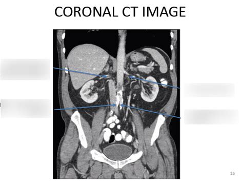 Abdominal Coronal Ct Image 2 Diagram Quizlet