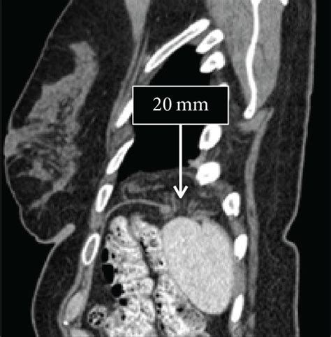 Axial A And Sagittal B And C Ct Scan Images Showing Diaphragmatic