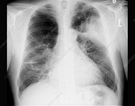 Bullous Emphysema X Ray Stock Image C0034685 Science Photo Library
