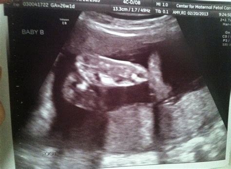luvlaughpray 26 weeks ultrasound pics h2o like a pro
