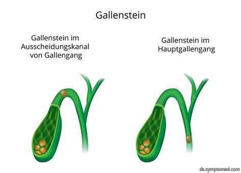 Diese gallensteine verursachen kontraktionen, die beim versuch, der in den gallenwänden der gallenwege gelegenen. Gallenkolik - Symptome