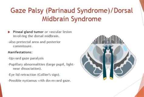 Parinaud Syndrome Flashcards Quizlet