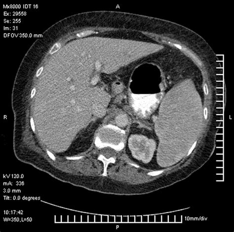 Abdominal Ct Scan Demonstrating Splenomegaly And Pathological