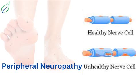 Peripheral Neuropathy Causes Symptoms And Treatments Best Back Pain