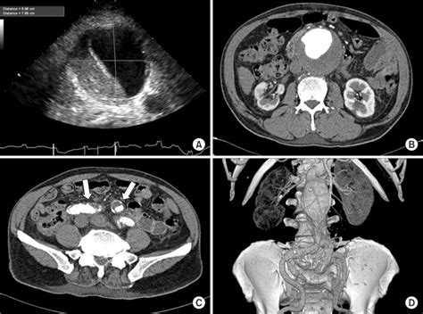 Ultrasonographic And Ct Findings Of Aaa A 76 Mm Abdominal Aortic