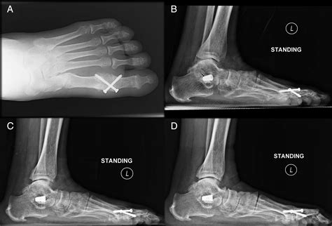 Spontaneous Subtalar Fusion An Irreversible Complication Of Subtalar