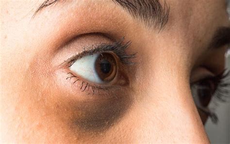 How To Remove Dark Circles Under Eyes Skinkraft