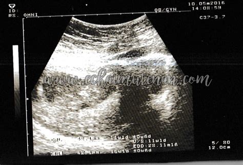 Produksi hormon estrogen dan progesteron ini akan meningkat saat kamu hamil dimungkinkan memberi kontribusi terhadap nyeri payudara. CeRiTa cHa: Cerita Kehamilan Bulan Ketiga