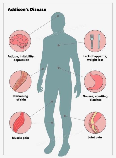 Figure Addisons Disease Symptoms Statpearls Publishing Illustration