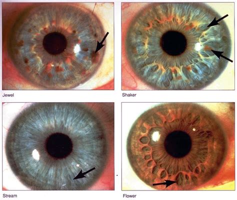 Sclerology Eye Chart Iriscope Iridology Camera Iriscope Camera