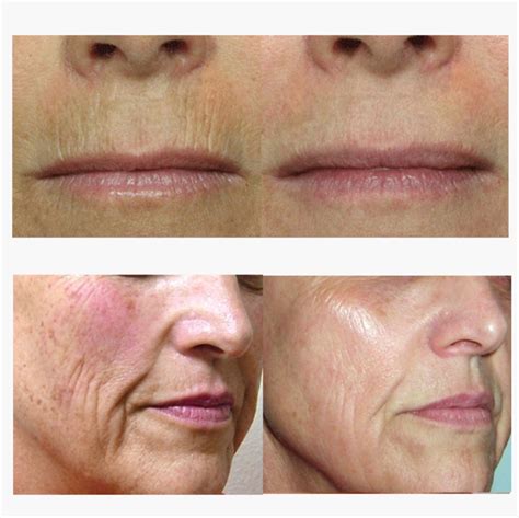 CO2 Fractional Laser Before And After