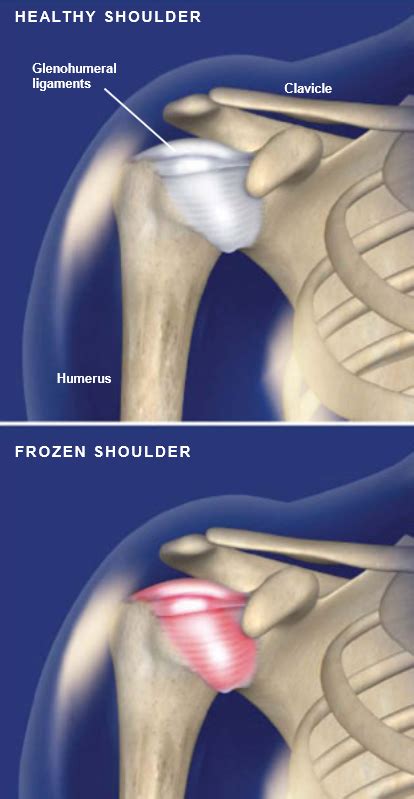 Frozen Shoulder Adhesive Capsulitis Central Coast Orthopedic