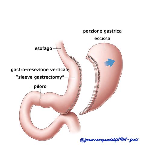 Gli alimenti più leggeri possono costituire un buon inizio. sindrome da "dumping" - per conoscere ciò che ci nutre