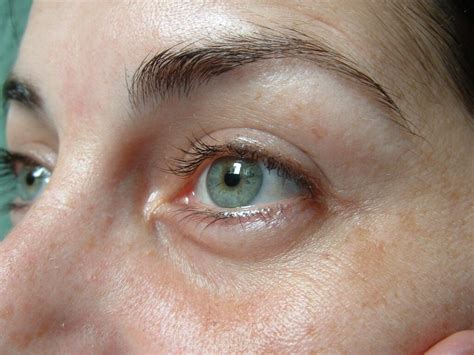 What Causes Dark Circles Around Your Eyes And How We Treat Them With