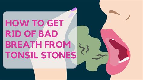 Bad Breath From Tonsil Stones How To Get Rid Of Bad Breath