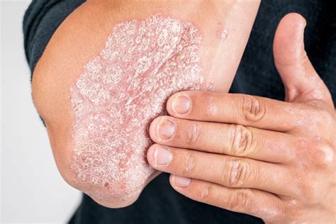 What Is Psoriasis Fatty Liver Disease
