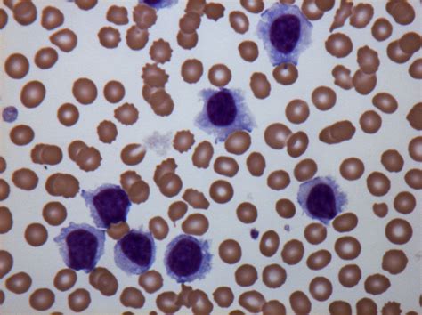 Interesting Case Of Lymphocytosis And Splenomegaly The Bmj
