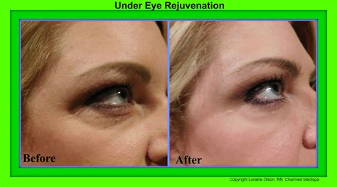 Under Eye Rejuvenation Without Surgery Charmed Medispa