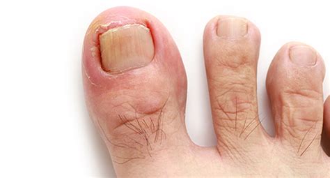Evidence of a toenail infection includes change in nail color which may be white, yellow, brown, or even black. Toenail Fungus Treatment in New York | Podiatrist in Manhattan