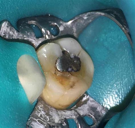 This high mercury content is incredibly dangerous because mercury is a toxic element. Safe Removal of Amalgam Fillings in Rockville Maryland