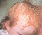 Telogen Effluvium Treatments Pictures