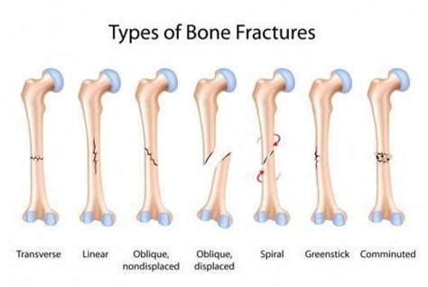 Types Of Long Bone Fractures