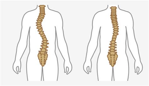 Causes And Symptoms Of Scoliosis Huffman Spine Clinic Scoliosis
