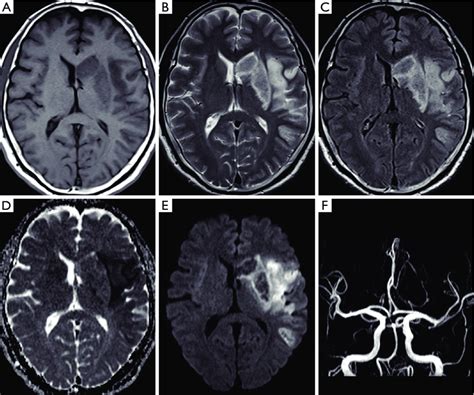 Magnetic Resonance Imaging Of A Patient With Left Middle Cerebral