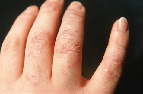 Allergic Reaction To Hand Sanitizer Captions Graphic