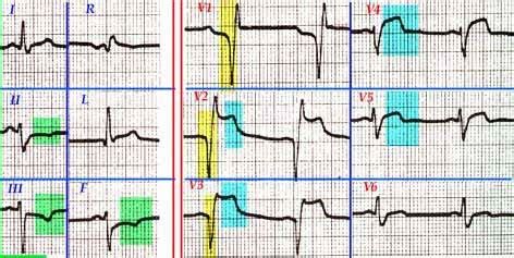 El ecg es básico en el. Infarto agudo de miocardio. Sindrome coronario agudo ...