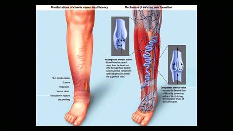 Tema Ulceras Vasculares Youtube