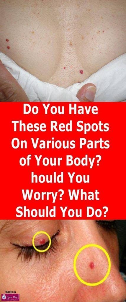 Do You Have These Red Spots On Various Parts Of Your Body Should You