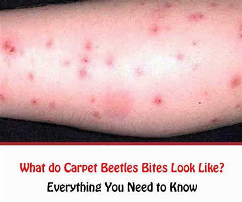 Do Carpet Beetle Bites Look Like Home Alqu