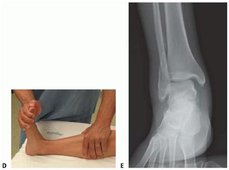 Open Reduction And Internal Fixation Of The Ankle Musculoskeletal Key