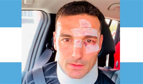 Al dt no le cabe una y, sin escarmentar, arribó a la argentina con transporte nuevo. Lionel Scaloni fuera de peligro tras accidente | KienyKe