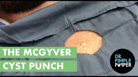 The Macgyver Cyst Punch Cystactular Cysts Dr Pimple Popper