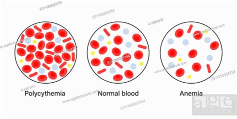 Normal Blood Polycythemia And Specimen With Anemia Disease Stock