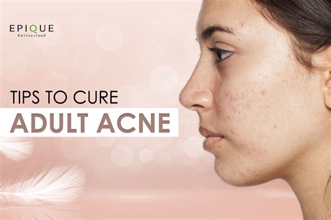 Adult Acne: Here’s Why You’re Breaking Up in Your 20s and 30s – MyEpique.in