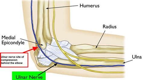 Ulnar Nerve Entrapment Cubital Tunnel