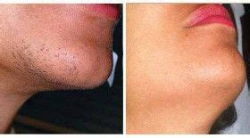 Laser hair removal is typically considered a medical procedure that requires a series of treatments to be effective. Chin Laser Hair Removal in Delhi, Chin Hair Removal Cost ...