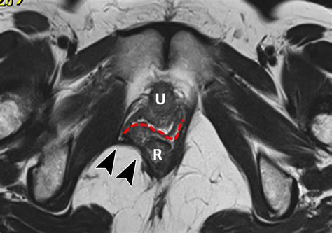 Translabial Us And Dynamic Mr Imaging Of The Pelvic Floor Normal