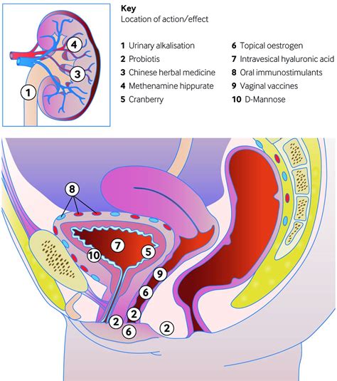 Non Antibiotic Options For Recurrent Urinary Tract Infections In Women