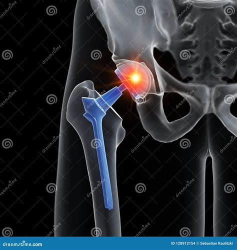 A Hip Replacement Stock Illustration Illustration Of Medicine 128912154
