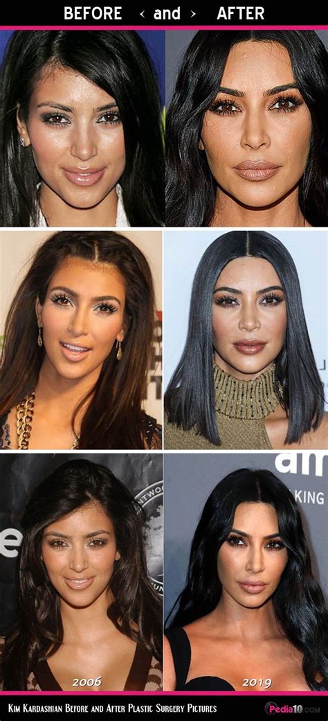 Kim Kardashian Face Pics Plastic Surgery Before And After Photo 2