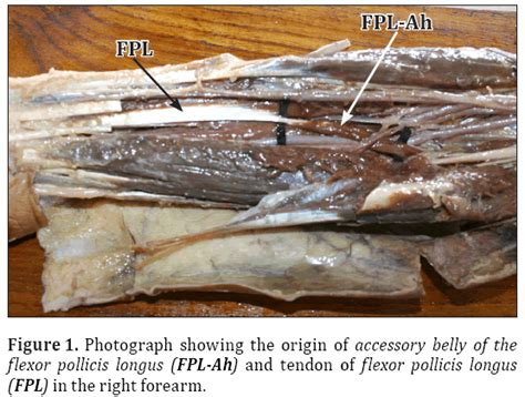 Injury to the flexor pollicis longus (fpl) tendon is one of the most frequent complications when fixing distal radius fractures with the volar locking plates. Gantzer of flexor pollicis longus - a culprit in Kiloh-Nevin syndrome