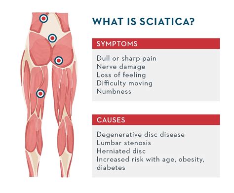 What Is Sciatica Symptoms And Causes And How To Deal With It By