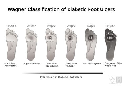 Diabetic Foot Ulcer Stages A Concise Guide My Endo Consult
