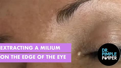 Extracting A Milia On The Edge Of The Eye Milia Madness Dr Pimple