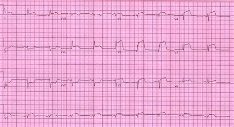 Stemi Case Examples Wikidoc