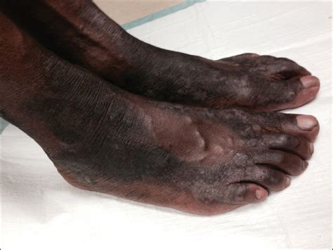 Hyperkeratotic Lesions In A Patient With Hepatitis C Virus Mdedge Dermatology